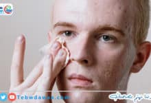 مشاكل حب الشباب