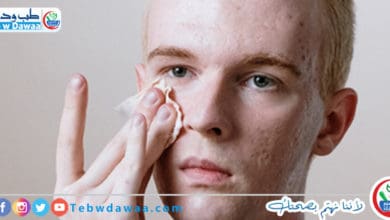 مشاكل حب الشباب