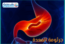 جرثومة المعدة 001