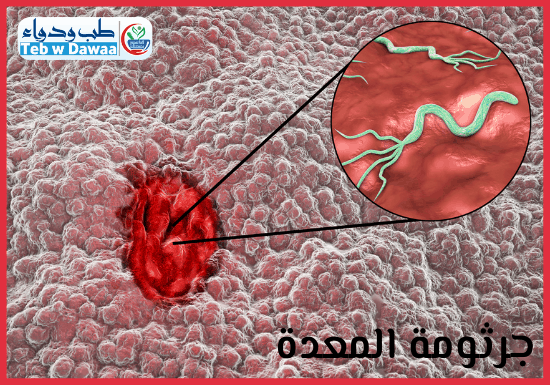 جرثومة المعدة 004