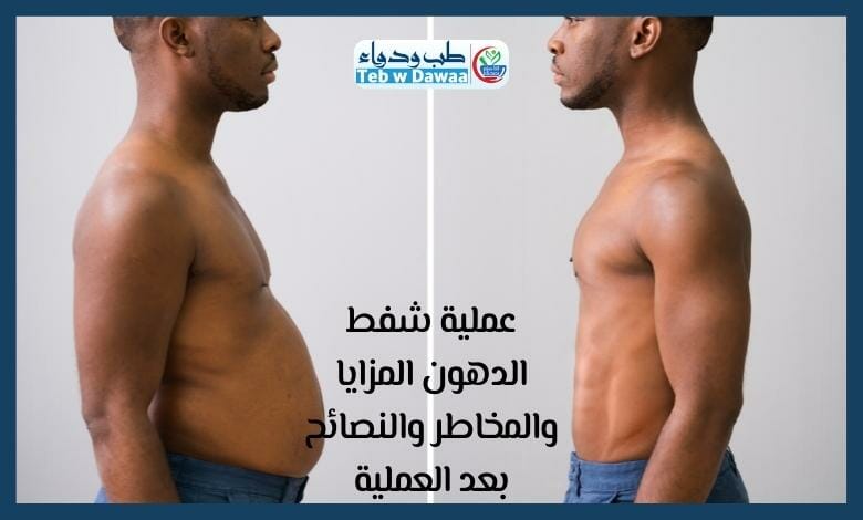 عملية شفط الدهون 004