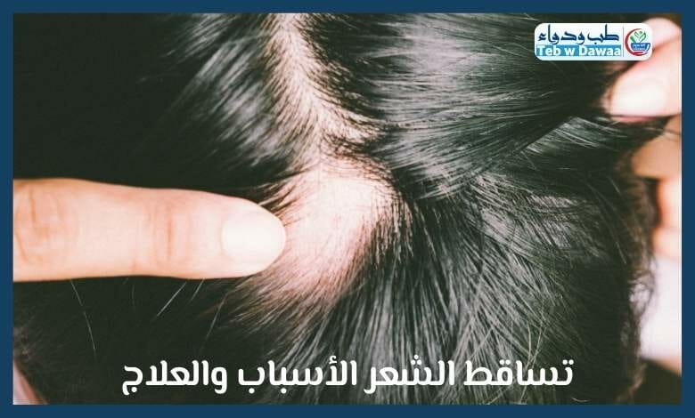 تساقط الشعر 003