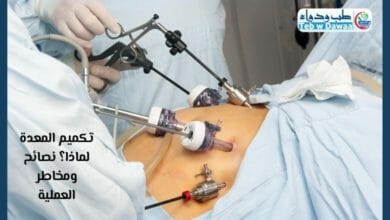 تكميم المعدة 001